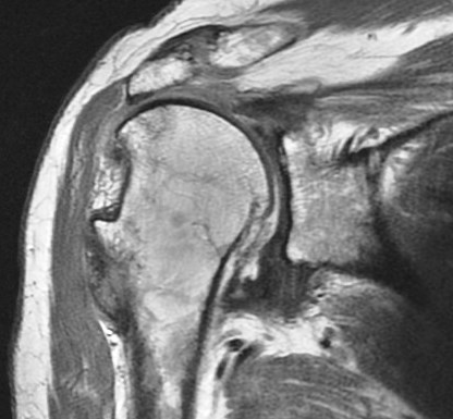 Figure 5 for case Greater tuberosity avulsion fracture
